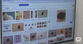 Día del melanoma: señales de alerta