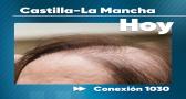 Conexión 1030: La alopecia en mujeres