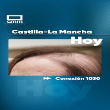 Conexión 1030: La alopecia en mujeres