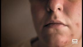 Lupus, la enfermedad de las mil caras