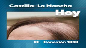 Conexión 1030: La alopecia en mujeres