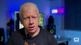 El albinismo, un trastorno genético que afecta a una de cada 17.000 personas en el mundo