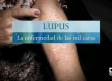 Lupus: la enfermedad de las mil caras