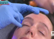 Tratamientos de belleza para terminar con las cicatrices