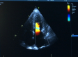 La hipertensión arterial pulmonar, una enfermedad rara, poco conocida y grave