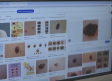 Día del melanoma: señales de alerta