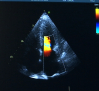 La hipertensión arterial pulmonar, una enfermedad rara, poco conocida y grave