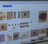 Día del melanoma: señales de alerta