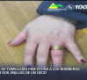 Una vecina de Tomelloso pide ayuda a los bomberos para sacar dos anillos de un dedo