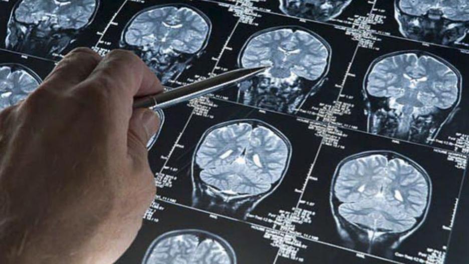 Cerebros con Alzheimer