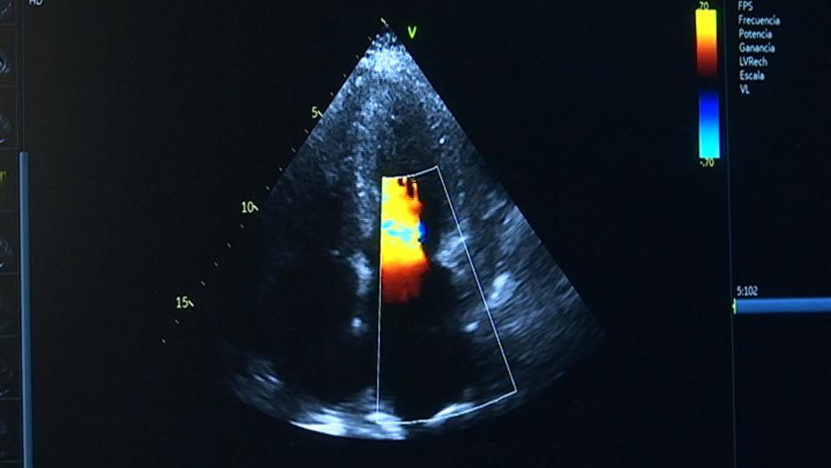 La hipertensión arterial pulmonar, una enfermedad rara, poco conocida y grave.