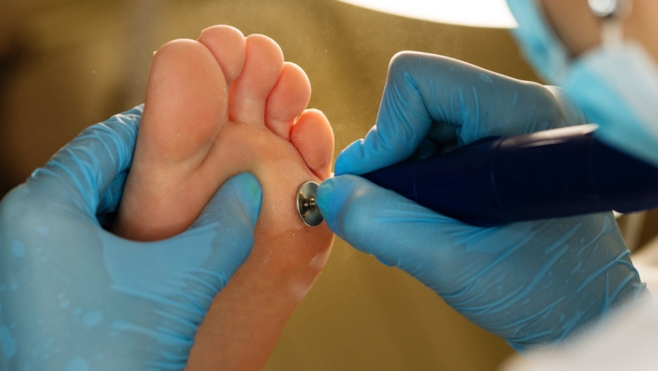 (Foto de ARCHIVO)
Hongos en los pies aumentan en verano.

REMITIDA / HANDOUT por QUIRÓNSALUD
Fotografía remitida a medios de comunicación exclusivamente para ilustrar la noticia a la que hace referencia la imagen, y citando la procedencia de la imagen en la firma
21/8/2025